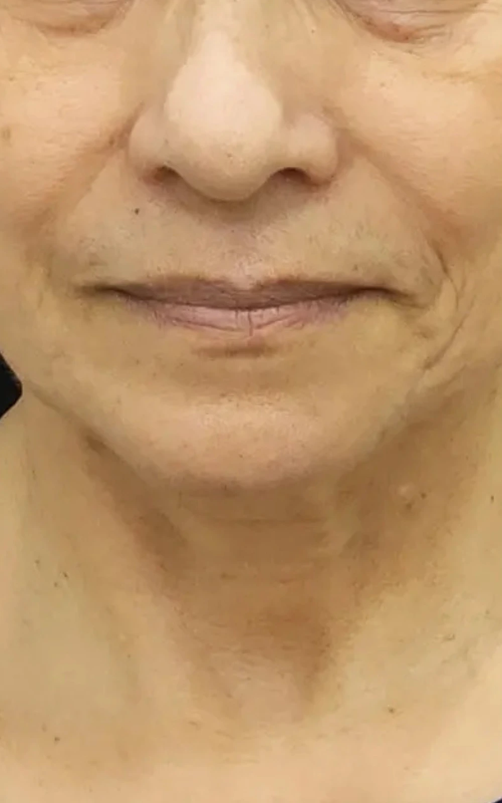 Antes - Rejuvenescimento do terço inferior do rosto