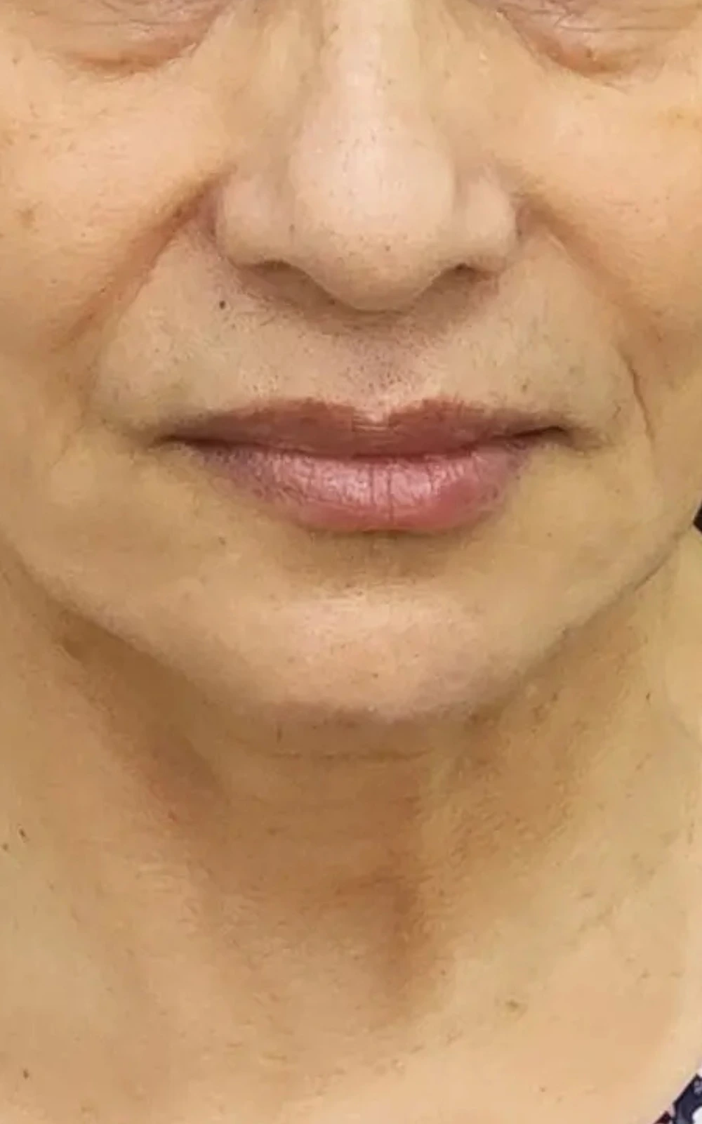 Depois - Rejuvenescimento do terço inferior do rosto